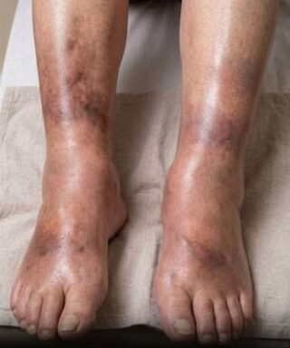 What Swollen Legs Could Tell You About Your Pancreatic Health