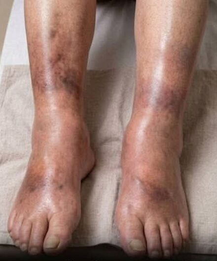 What Swollen Legs Could Tell You About Your Pancreatic Health