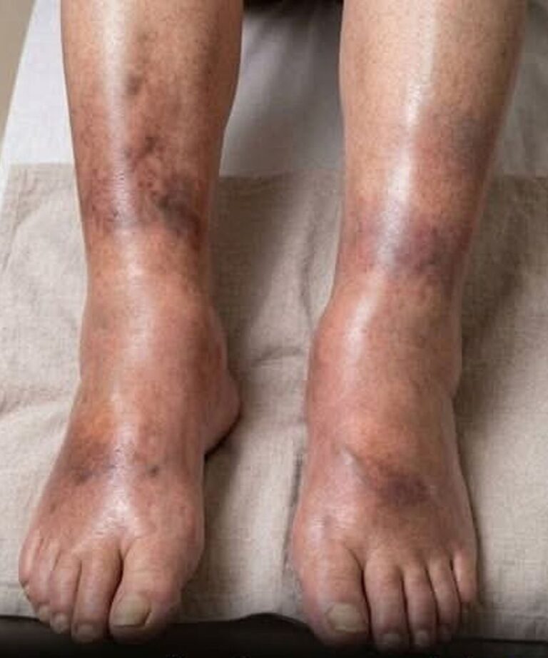 What Swollen Legs Could Tell You About Your Pancreatic Health